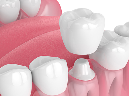 The image displays a close-up view of multiple teeth with varying shades of pink and white, suggesting a dental care theme.