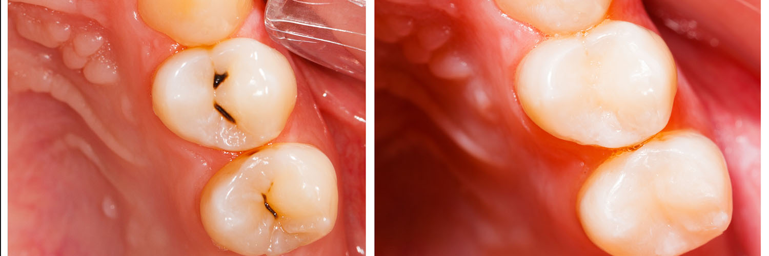 The image shows a close-up of an open mouth with teeth and gums, displaying a dental implant and partial dentures on either side of the missing tooth.