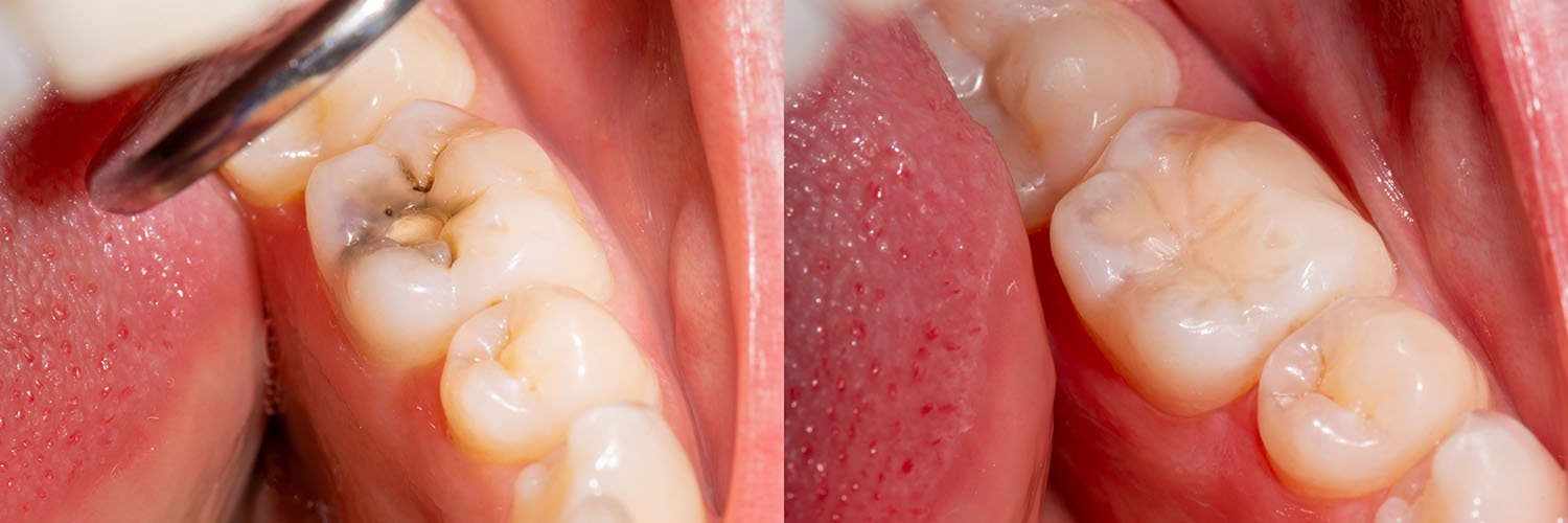The image shows a close-up view of a mouth with several teeth, some of which appear damaged or decayed, with a focus on the lower front area where there is visible tooth wear and discoloration.
