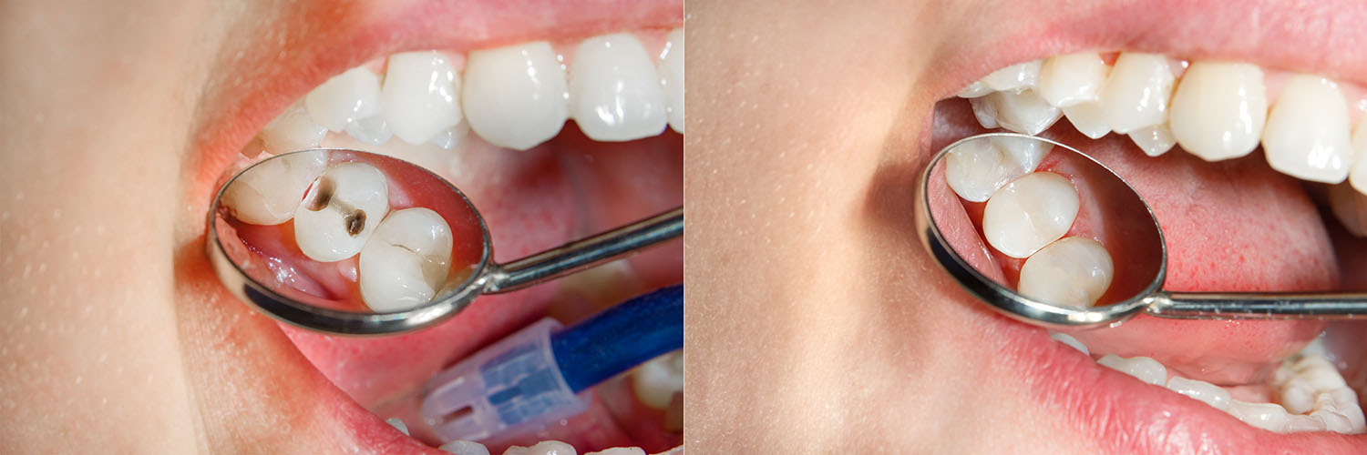 A close-up photograph of a person s mouth with an open toothbrush, showing teeth and tongue, placed between two images of a dental drill and a toothbrush.
