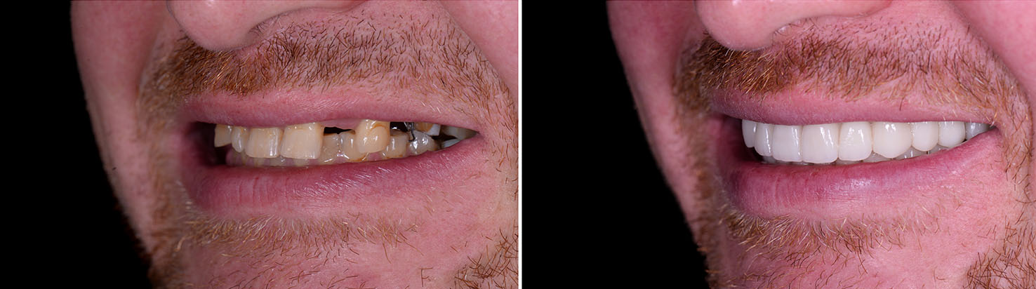 The image shows a man with a beard smiling at the camera, displaying his teeth, and showing two different states of his mouth before and after dental work, with the left side of his face appearing normal and the right side showing signs of dental issues such as tooth damage and decay.